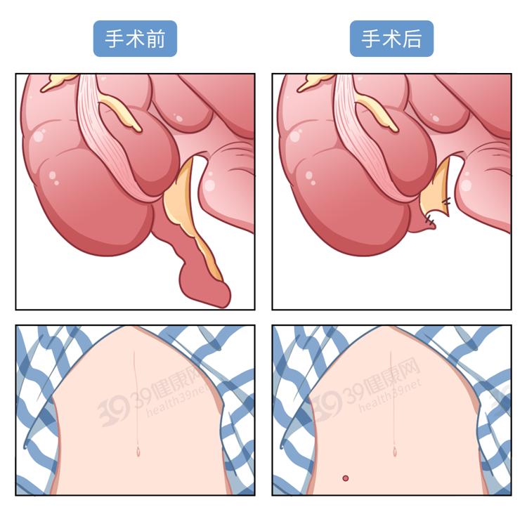 急性阑尾炎疼到什么程度,急性阑尾炎为什么那么急