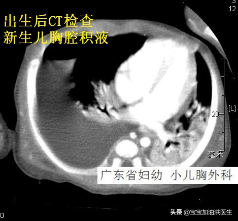 还没生就流虚汗,胸腔里有积水是怎么回事