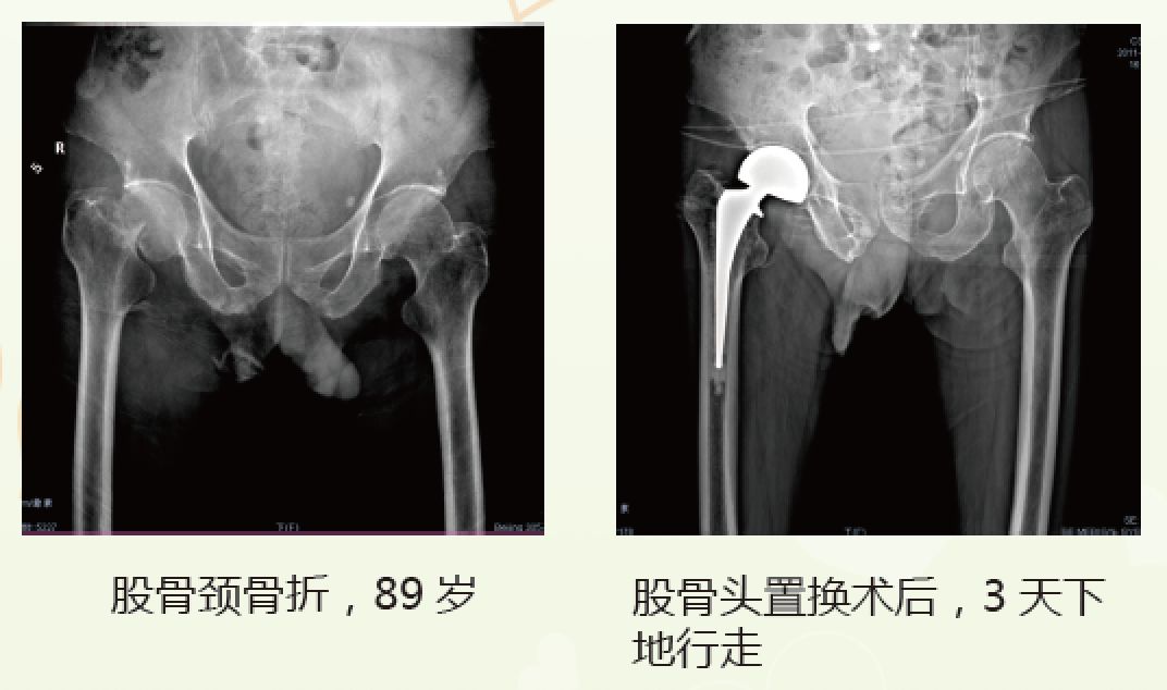 老年髋部骨折最常见的部位,髋部骨折危害大老年人摔伤要重视