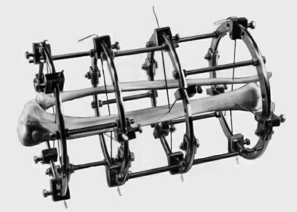 做断骨增高手术会残疾吗,断骨增高术一般可以增高几厘米