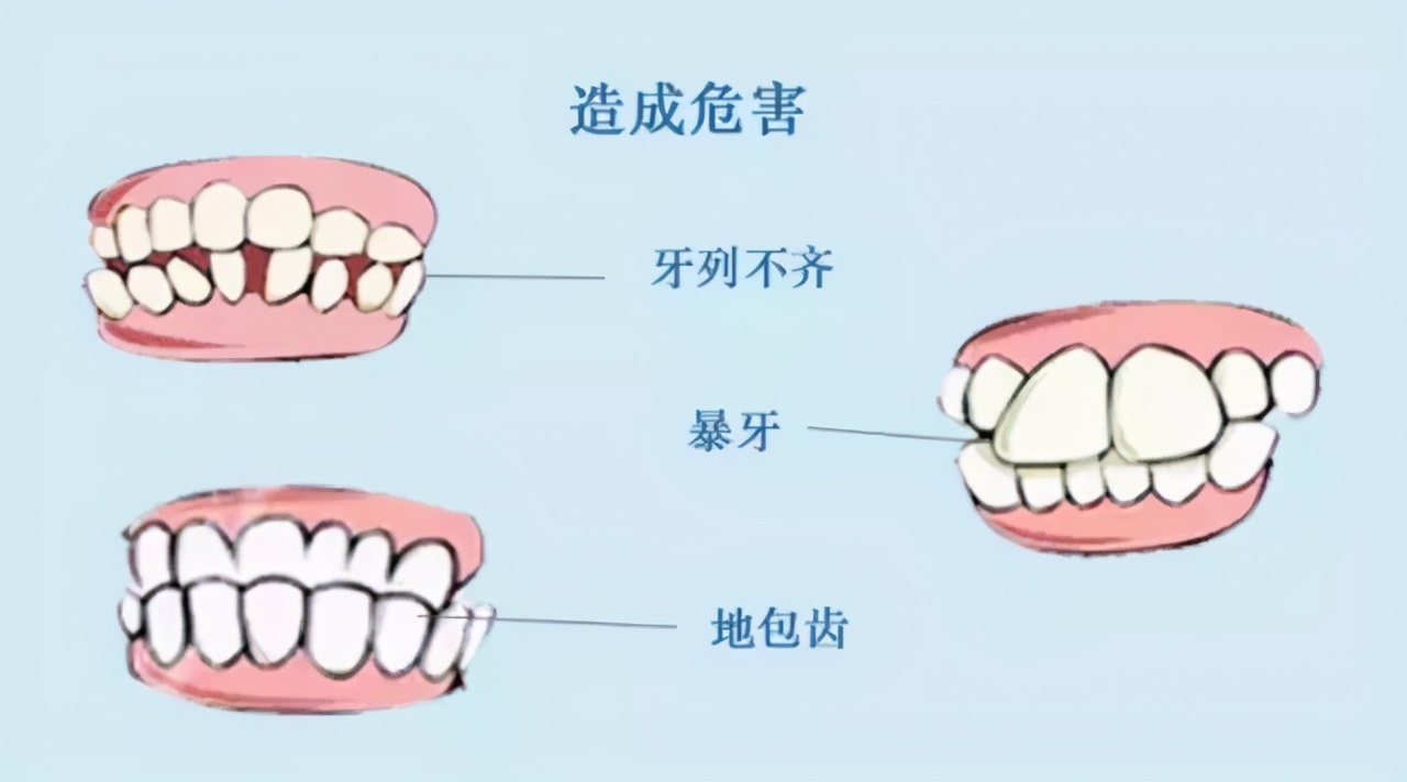 孩子开始换牙需要注意什么,孩子换牙期间这5件事需重视