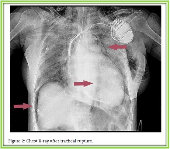 全麻拔管后意外气管破裂怎么办？