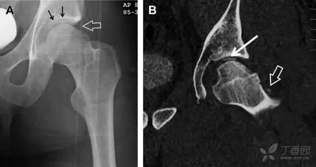 放射科夜班病例大全,放射科容易漏诊的骨折
