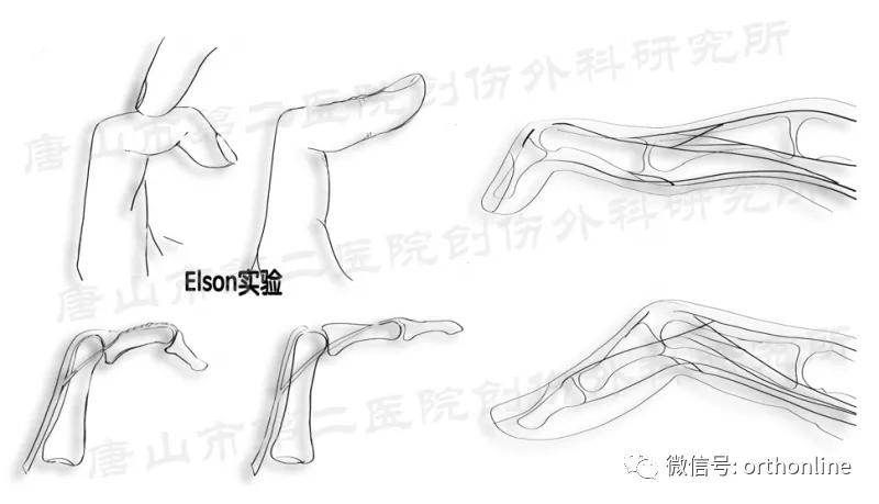 手部肌腱不完全断裂能完全复原吗,手部屈指肌腱损伤最难处理的部位