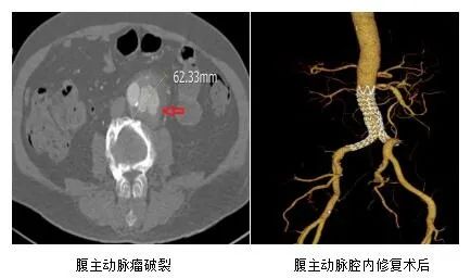 主动脉瘤患者的微创“拆弹”专家——山东大学齐鲁医院（青岛）孙念峰教授血管外科专业团队