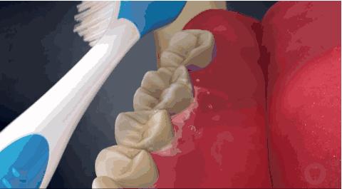 修复缺牙的最好方法,告别“老掉牙”看清这些招