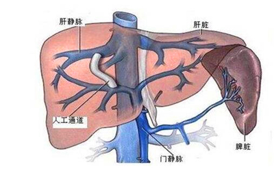 得过肝硬化可以做胃镜吗,肝硬化做胃镜为什么要最后做呢