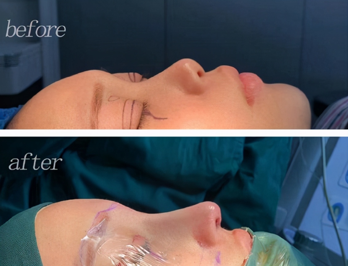 隆鼻对皮肤有什么影响,隆鼻对颜值有多大影响