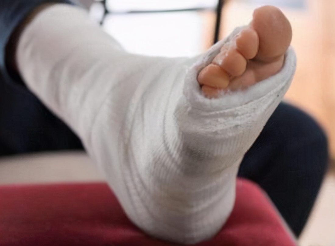 跟腱断裂后的非手术康复方案