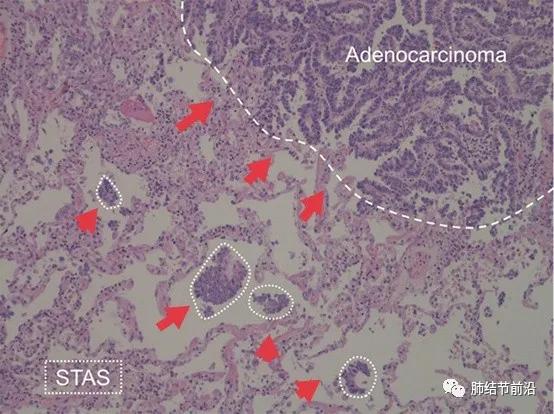 肺癌的肺泡间转移,STAS对肺结节临床处理的指导意义