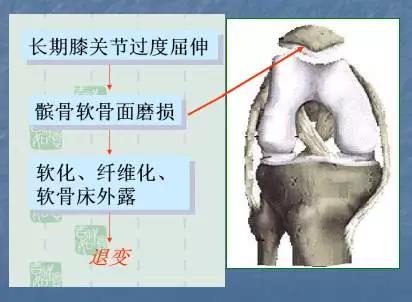 膝骨性关节炎的临床表现,膝骨性关节炎的康复治疗方法