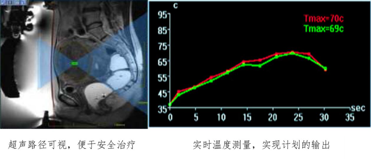 震颤磁波刀帕金森,磁波刀震颤全国哪家医院有