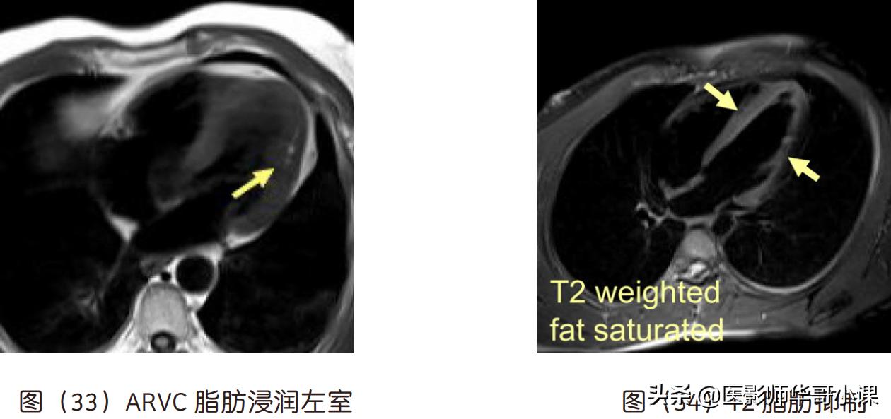 心脏mr增强扫描讲解,磁共振心脏扫描标准切面