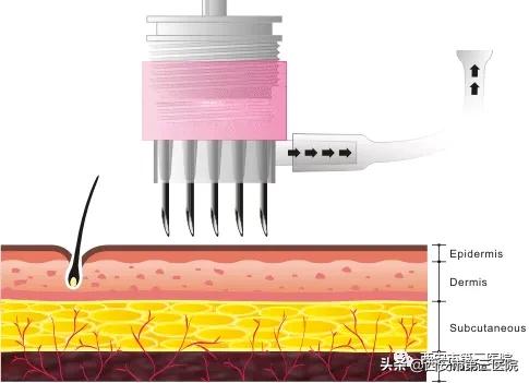 紧致肌肤的微针,淡化细纹微针