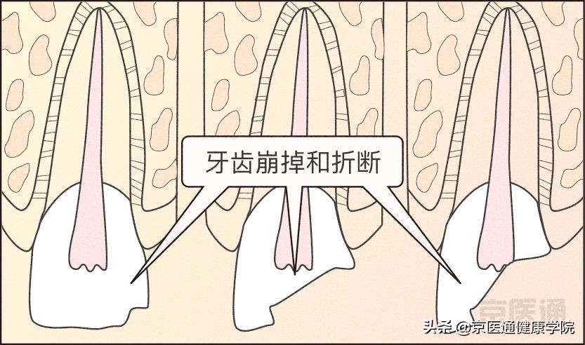 一招解决磨牙的危害,磨牙很严重最好的磨牙解决方法