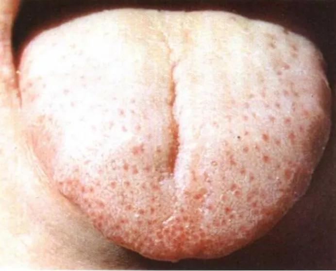 正确的舌诊图解及用药,感冒舌诊