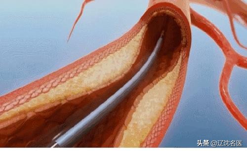 脑血栓血栓一年了还可以取出吗,脑血栓怎么取出血栓