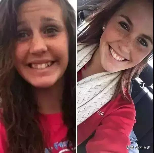 牙齿矫正换脸视频,牙齿矫正颜值有多大改变图片