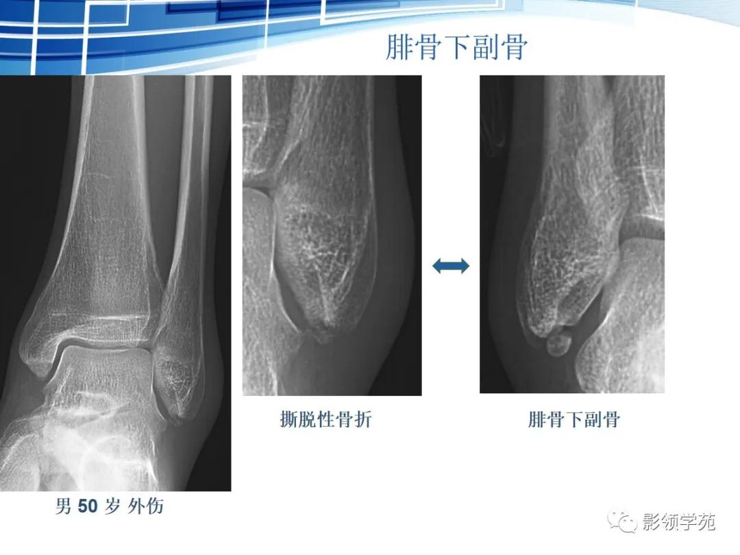 桡骨远端骨折引起尺骨变异,撕脱骨折一个月无明显骨痂形成