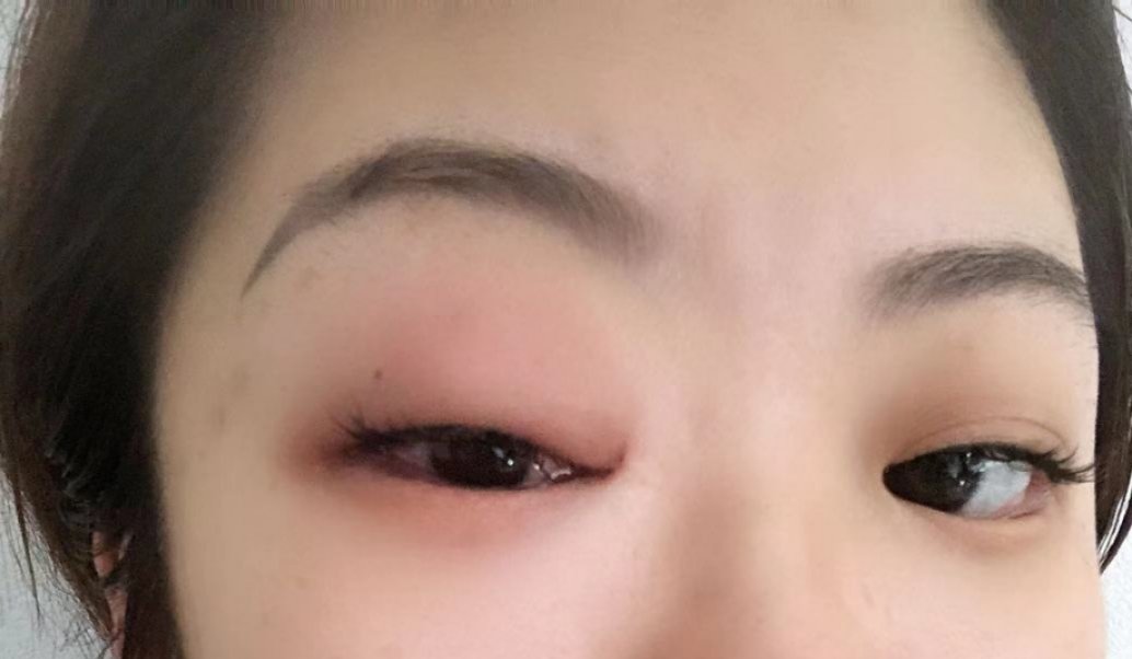 中医治疗眼部皮肤过敏,眼部红肿痒中医治疗