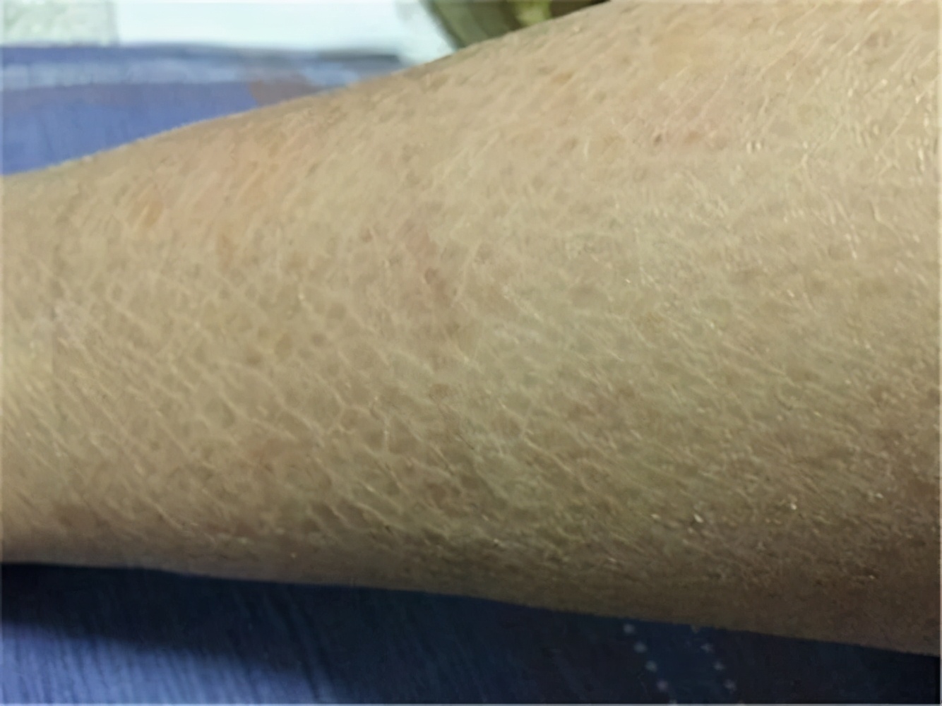 如何消除鸡皮肤学生党,告别蛇皮肌肤