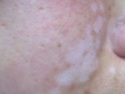 皮肤白癜风怎么治疗最有效,治白癜风的偏方快速治好白癜风