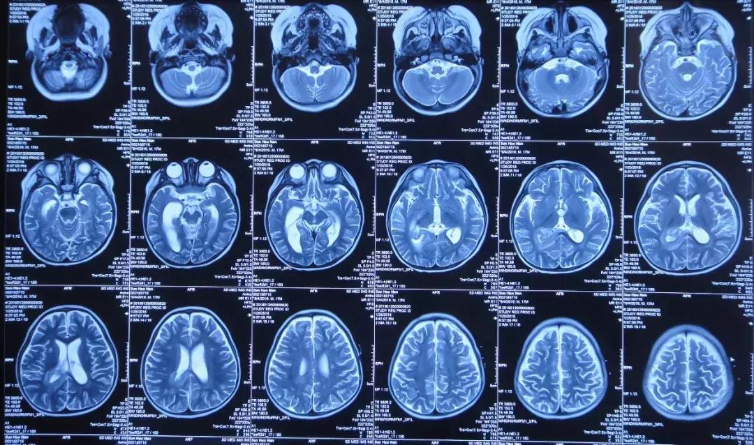 孩子脑积水反复发烧,婴儿脑积水引起发烧如何保守治疗