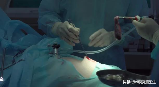 腹腔镜输卵管整形术全过程,腹腔镜做宫外孕开窗取胚术演示