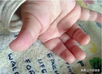 宝宝冬季出现冻疮怎么办？