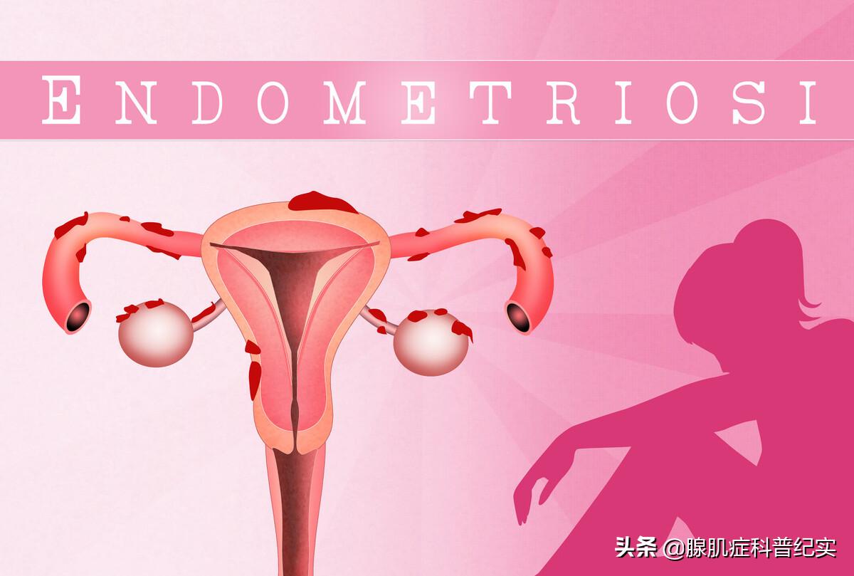 腺肌症做子宫切除还是做栓塞术好,宫腔粘连和腺肌症可以自然怀孕吗