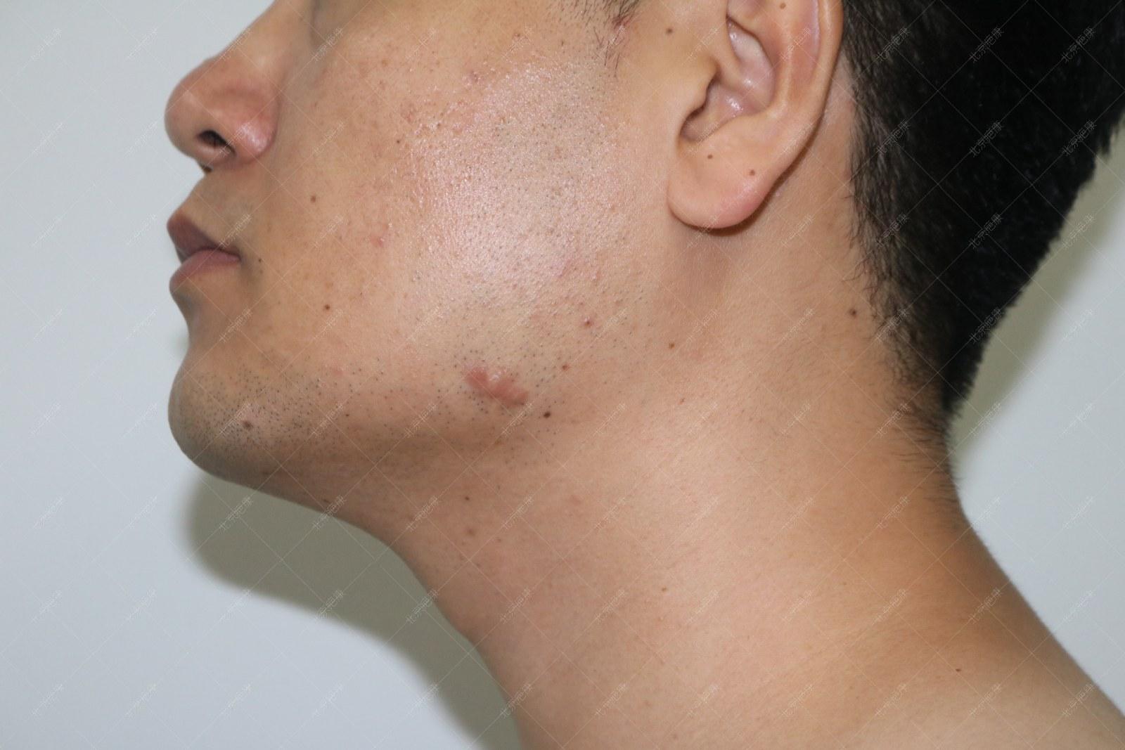 疤康疤痕疙瘩治疗效果怎么样,疤康治疗效果是真实的吗