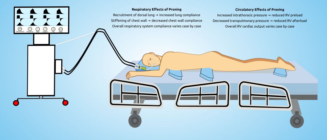 ards急性呼吸窘迫综合征分型,呼吸窘迫综合征诊疗指南