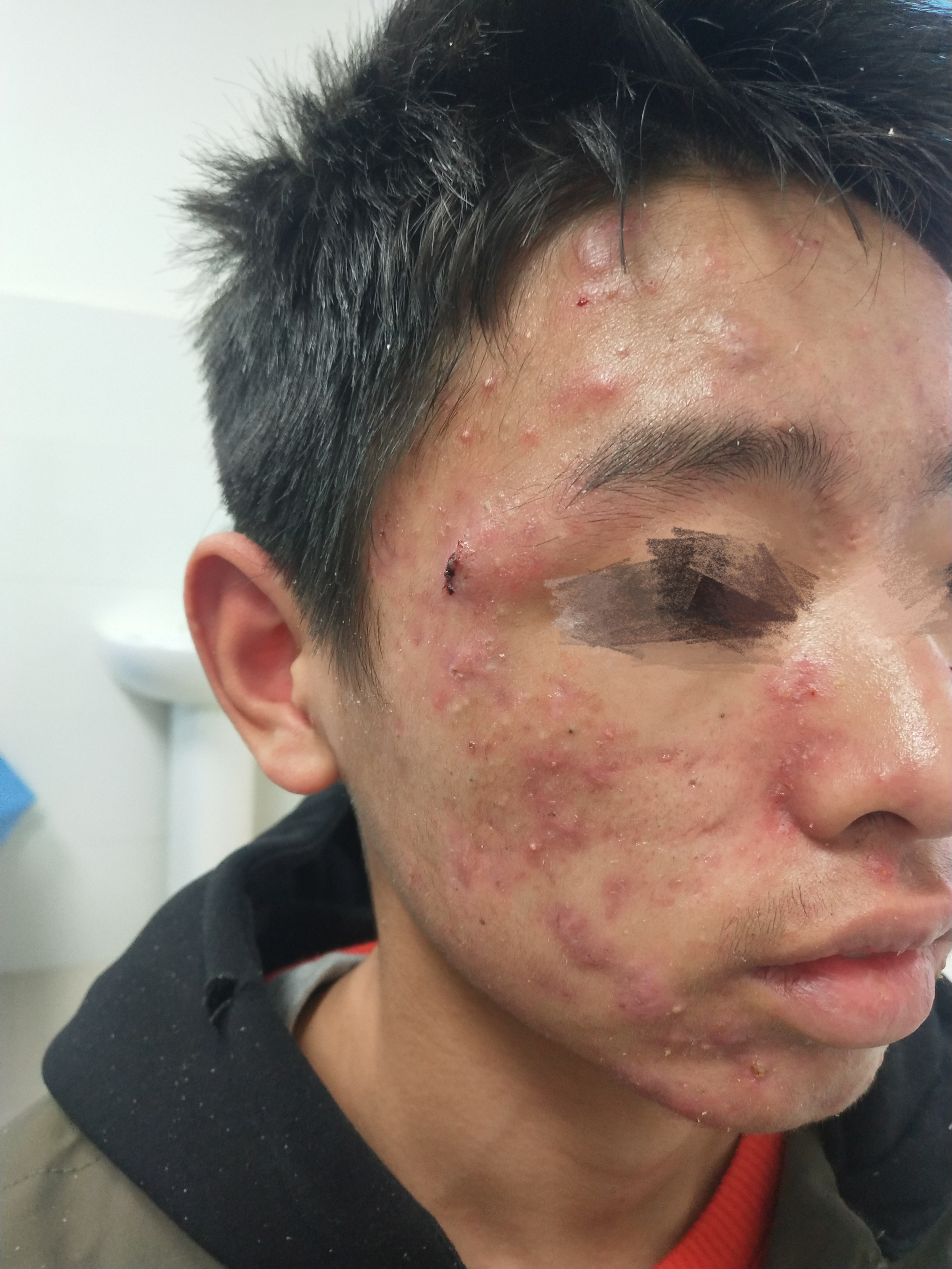 16岁男孩子脸部痘痘严重,16岁男孩身上长痤疮怎么治疗