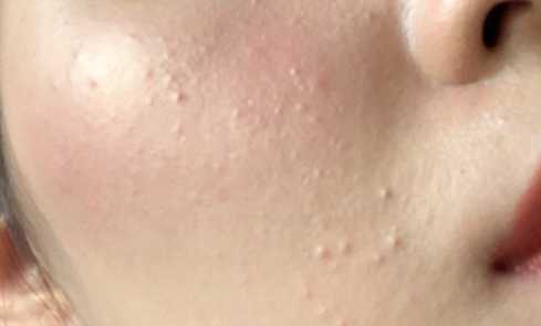 长痘痘的症状有哪些呢,长痘痘的原因及解决方法