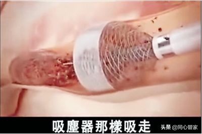 是不是有的血栓也不要过度治疗,能彻底治疗血栓吗