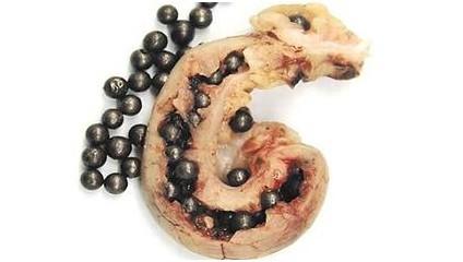 阑尾里边有粪石需要及时手术吗,阑尾粪石会引起异物感么