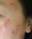 色素痣可以随意的祛除吗,无色素痣怎么去除