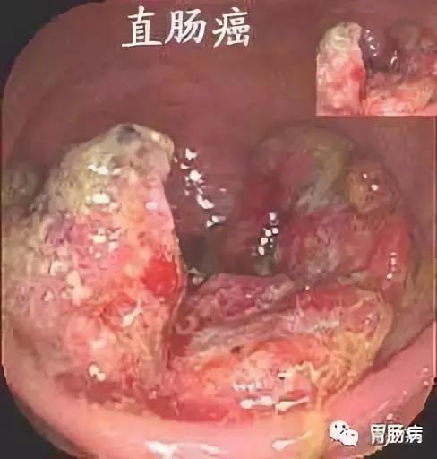 直肠癌误诊为痔疮5年,直肠癌与痔疮便血区别在哪些