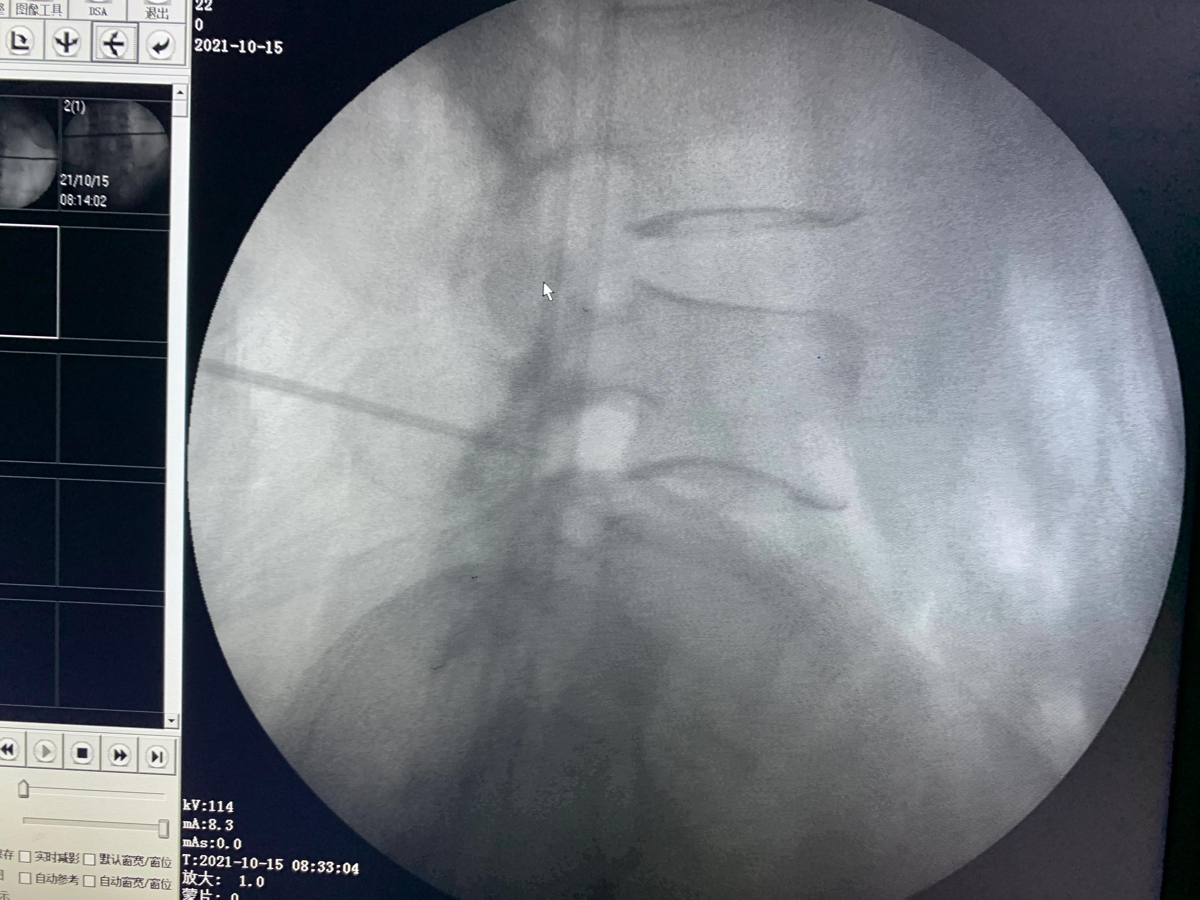 椎间孔镜术后腰痛症状多久消失,盘源性腰痛手术后易复发吗