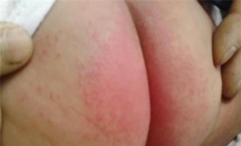 皮肤发痒抹炉甘石就好什么原因,皮肤痒擦炉甘石有用吗