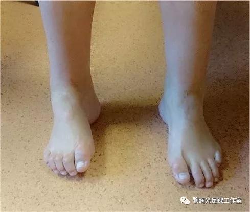 伊里扎洛夫外固定架治疗足部畸形,足部畸形矫正的技巧