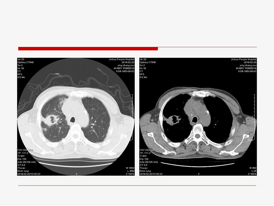 像炎症的肺癌能治好吗,医生说可能是肺癌也可能是炎症