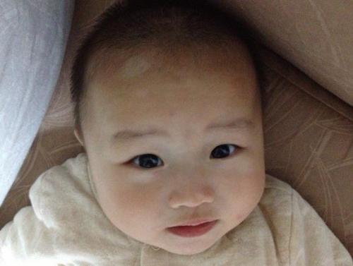 白斑随“期”而变，不同时期白癜风的特点你知道多少？