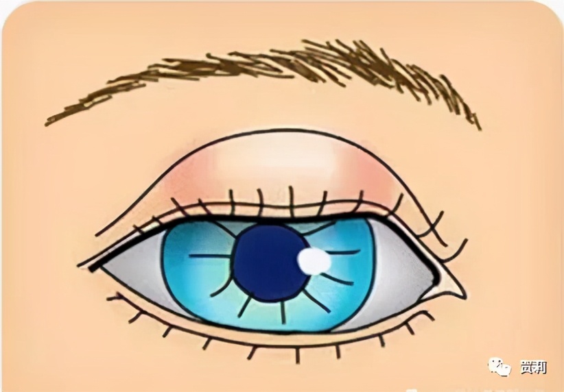 睑板腺囊肿眼皮图片,睑板腺囊肿眼皮肿怎么办