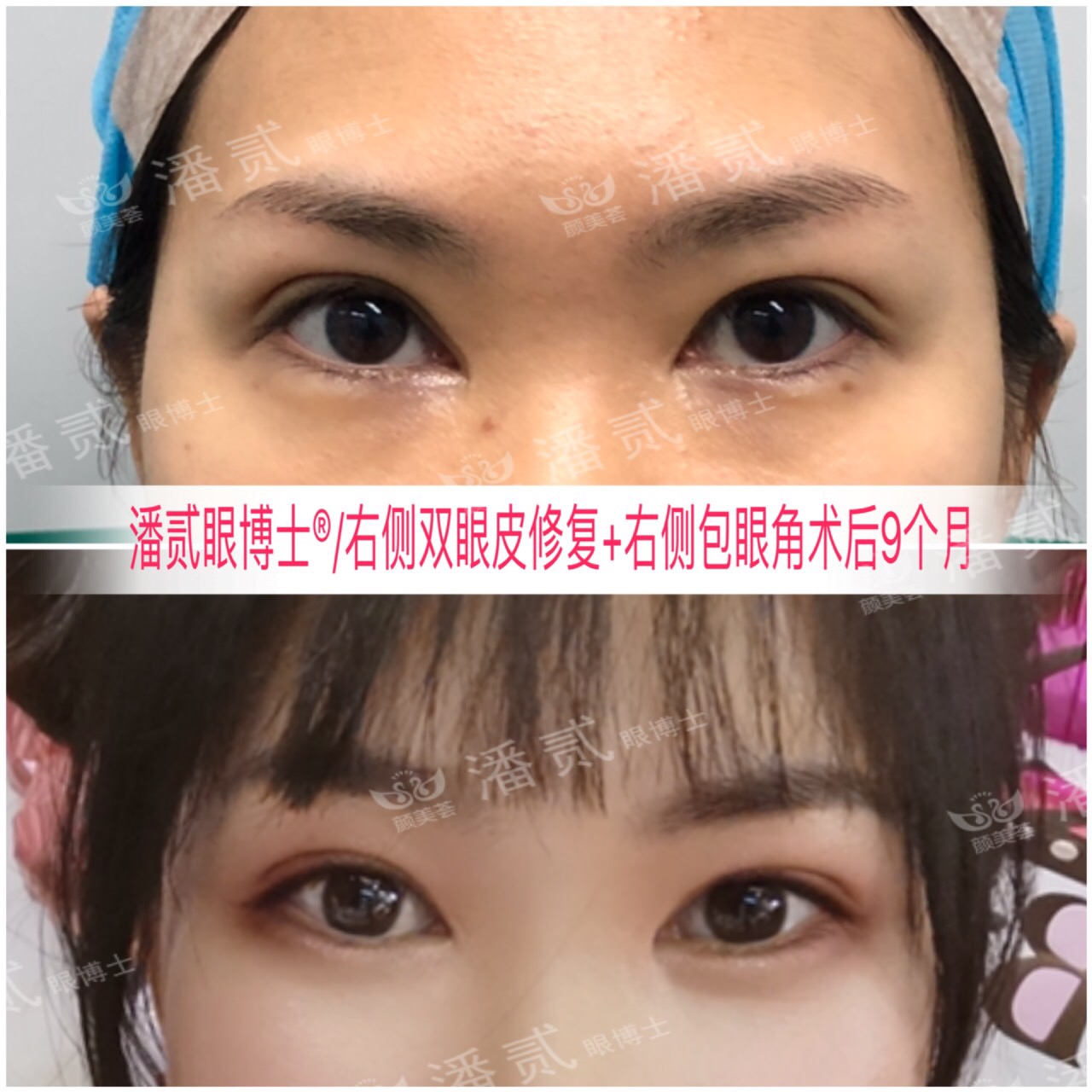 开内眼角会留疤的照片,开内眼角的疤痕变白色了怎么办