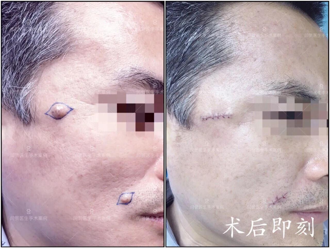 脚底有痣激光还是手术切除,黑色素痣手术切除还是激光去除好