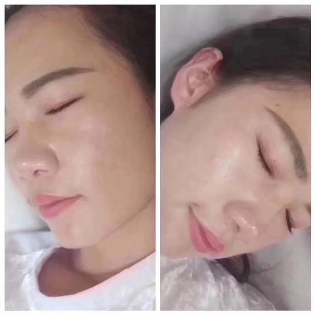 七老治疗激素脸怎么样,七老治疗激素脸真的管用吗