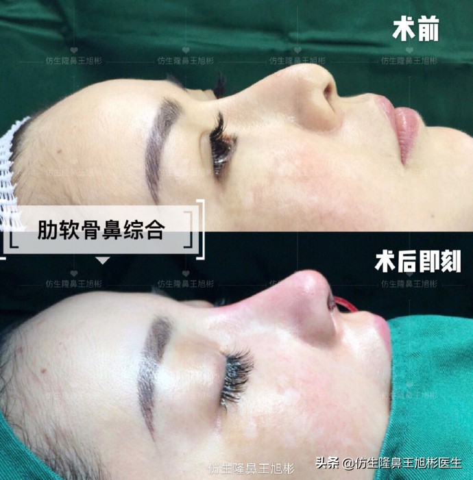 “鹰钩鼻”显凶又显老,是如何矫正的?