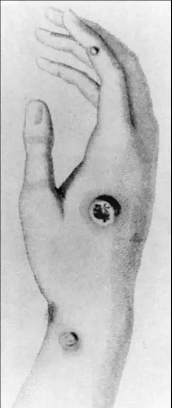 人类历史上第一次被消灭的传染病,人类战胜的传染病