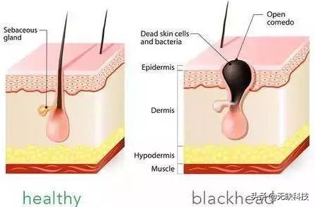 不管黑头的后果,不管黑头行吗